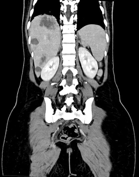 File:Choriocarcinoma liver metastases (Radiopaedia 74768-85766 B 75).jpg
