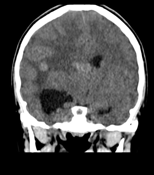 File:Choroid plexus carcinoma (Radiopaedia 91013-108552 Coronal non-contrast 41).jpg