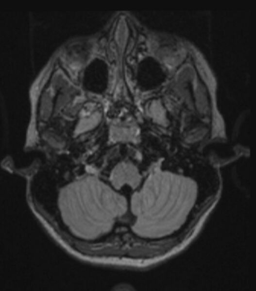File:Choroid plexus carcinoma (Radiopaedia 91013-108553 Axial FLAIR C+ 86).jpg