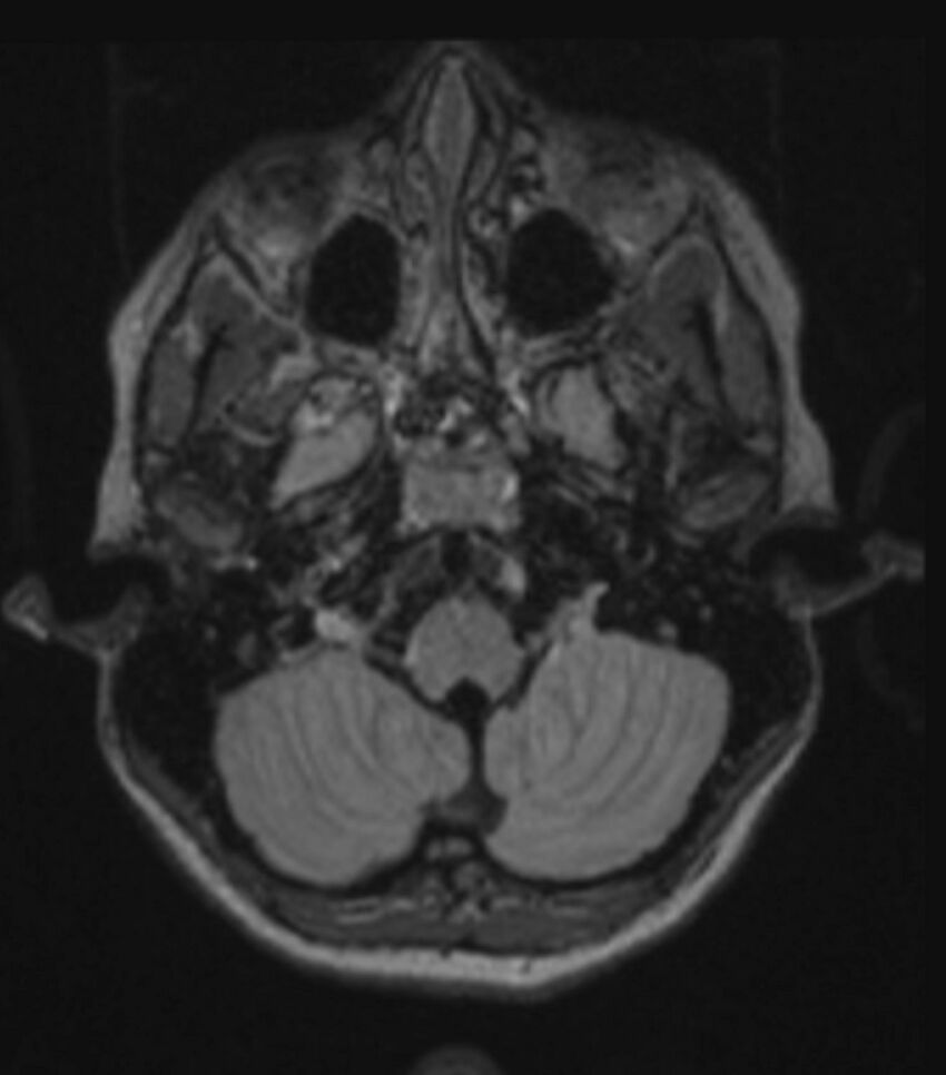 Choroid plexus carcinoma (Radiopaedia 91013-108553 Axial FLAIR C+ 86).jpg
