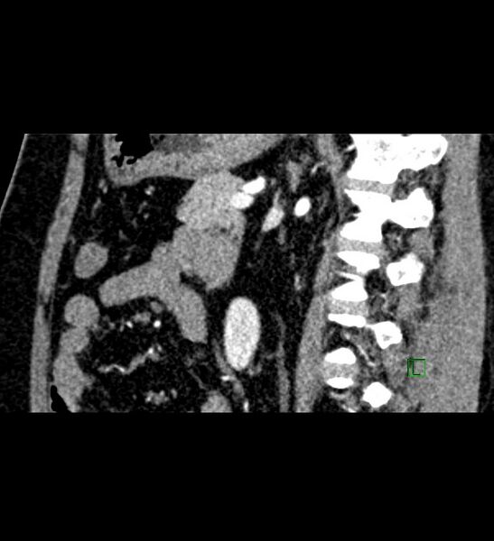 File:Chromophobe renal cell carcinoma (Radiopaedia 84286-99573 F 69).jpg