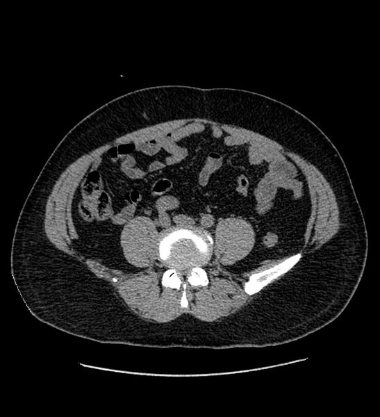 File:Chromophobe renal cell carcinoma (Radiopaedia 84337-99693 Axial non-contrast 100).jpg