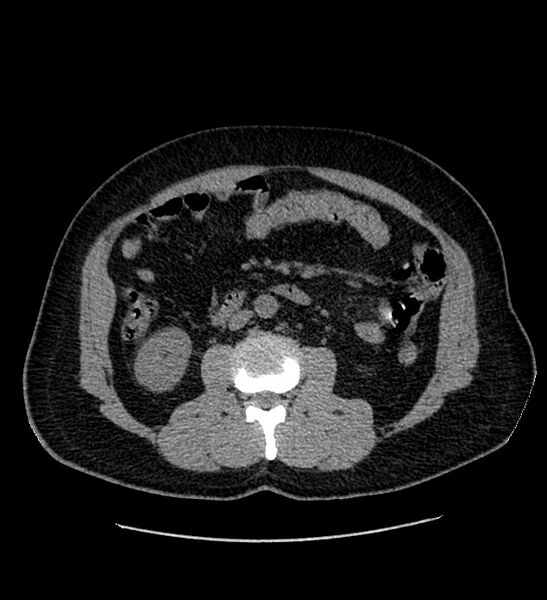 File:Chromophobe renal cell carcinoma (Radiopaedia 84337-99693 Axial non-contrast 68).jpg
