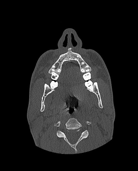 File:Chronic maxillary sinusitis caused by a foreign body (Radiopaedia 58521-65676 Axial bone window 29).jpg