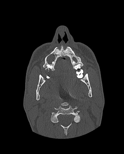 File:Chronic maxillary sinusitis caused by a foreign body (Radiopaedia 58521-65676 Axial bone window 45).jpg
