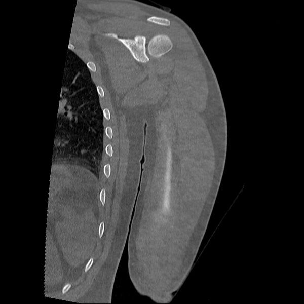 File:Chronic osteomyelitis (Radiopaedia 67597-76998 Coronal bone window 15).jpg