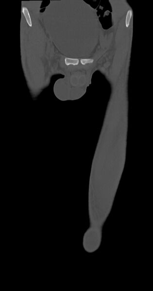 File:Chronic osteomyelitis (with sequestrum) (Radiopaedia 74813-85822 Coronal non-contrast 7).jpg