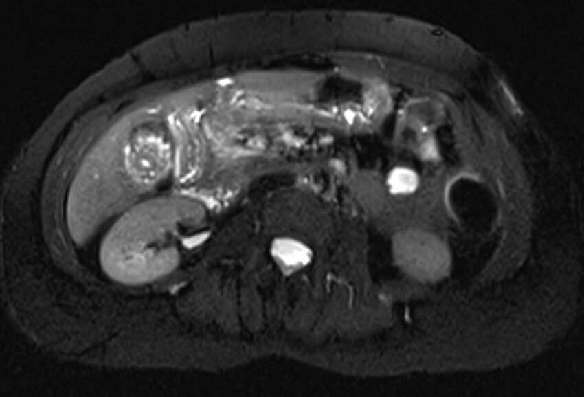 Chronic pancreatitis - pancreatic duct calculi (Radiopaedia 71818-82250 Axial T2 fat sat 37).jpg