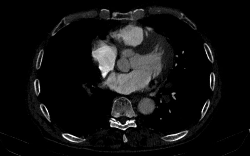 File:Chronic pulmonary embolism (Radiopaedia 91241-108843 B 119).jpg