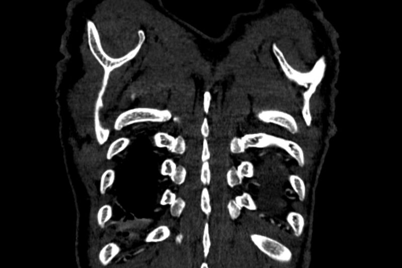 File:Chronic pulmonary embolism with bubbly consolidation (Radiopaedia 91248-108850 B 139).jpg