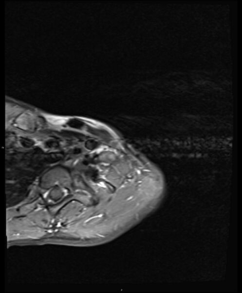 File:Chronic reactive multifocal osteomyelitis (CRMO) - clavicle (Radiopaedia 56406-63114 Axial T1 C+ fat sat 4).jpg