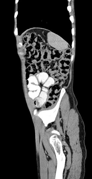 File:Chronic small bowel volvulus (Radiopaedia 75224-86322 C 29).jpg