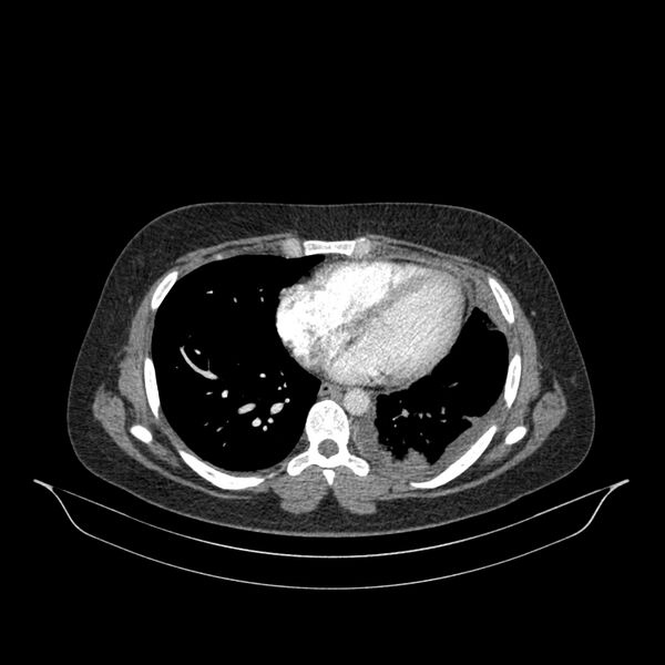 File:Chronic thromboembolic pulmonary hypertension (CTEPH) (Radiopaedia 74597-85532 Axial C+ CTPA 62).jpg