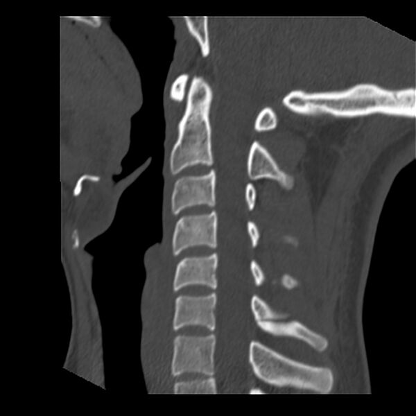 File:Clay-shoveler fracture (Radiopaedia 22568-22590 Sagittal bone window 23).jpg