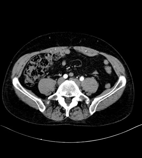 File:Clear cell renal cell carcinoma (Radiopaedia 85006-100539 B 61).jpg