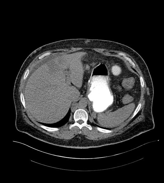 File:Closed-loop small bowel obstruction-internal hernia (Radiopaedia 78439-91096 Axial non-contrast 32).jpg