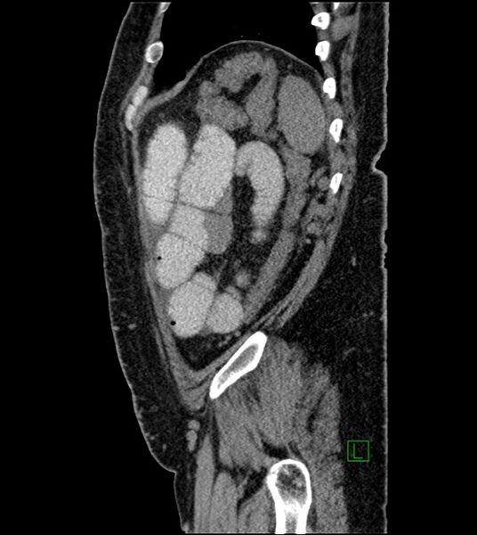 File:Closed-loop small bowel obstruction-internal hernia (Radiopaedia 78439-91096 C 32).jpg