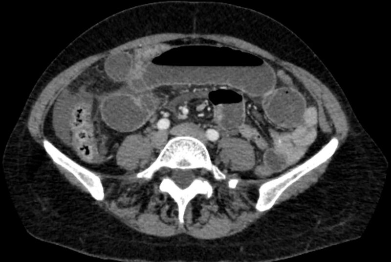 File:Closed loop small bowel obstruction (Radiopaedia 71211-81508 A 84).jpg