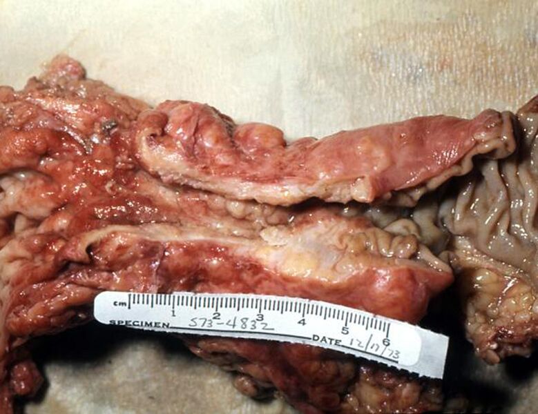 File:Colorectal adenocarcinoma (gross pathology) (Radiopaedia 36371).jpg