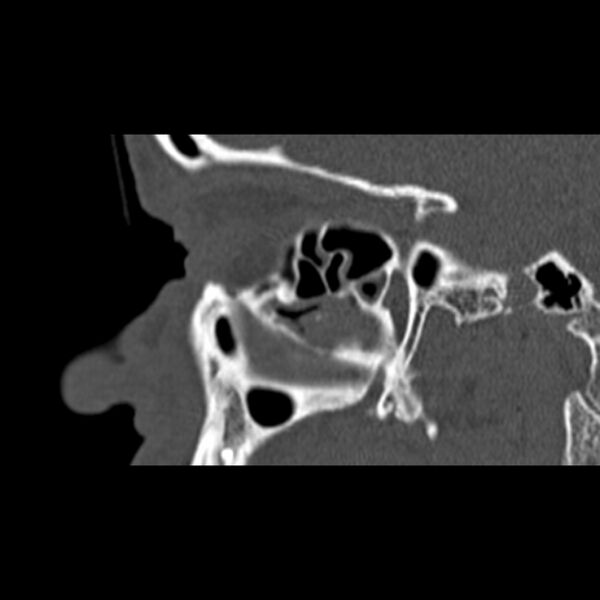 File:Nasal septal perforation (Radiopaedia 25030-25289 Sagittal bone window 9).jpg