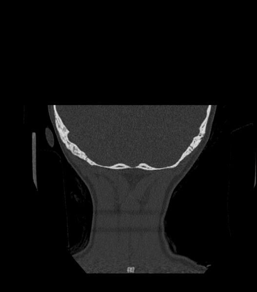 File:Nasoorbitoethmoid fracture (Radiopaedia 90044-107205 Coronal bone window 134).jpg