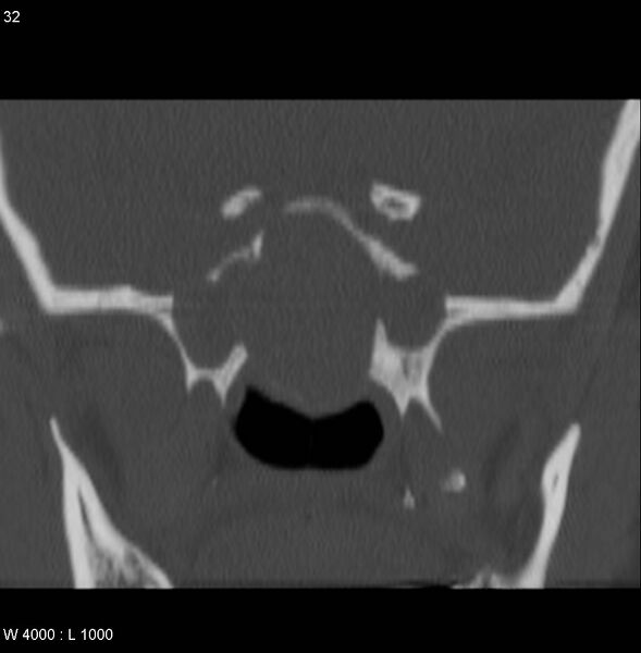 File:Nasopharyngeal carcinoma (recurrent) (Radiopaedia 5061-6903 Coronal bone window 9).jpg