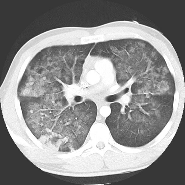 File:Near drowning pulmonary edema (Radiopaedia 16868-16591 Axial lung window 21).jpg