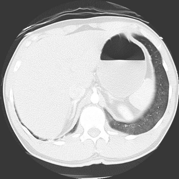 File:Near drowning pulmonary edema (Radiopaedia 16868-16591 Axial lung window 52).jpg