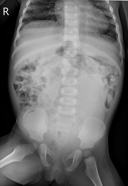 File:Neuroblastoma (Radiopaedia 41472-44354 Frontal 1).PNG