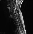 Neurofibromatosis type 2 - cranial and spinal involvement (Radiopaedia 5351-7112 Sagittal T2 3).jpg