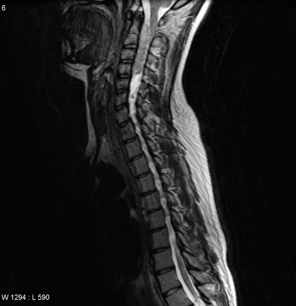 File:Neurofibromatosis type 2 - cranial and spinal involvement (Radiopaedia 5351-7112 Sagittal T2 3).jpg