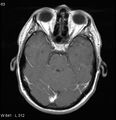 Neurosarcoidosis (Radiopaedia 10930-17204 Axial T1 C+ 6).jpg
