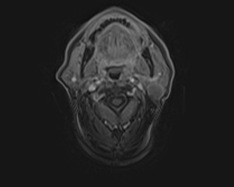 File:Non-Hodgkin lymphoma - parotid gland (Radiopaedia 71531-81890 E 35).jpg