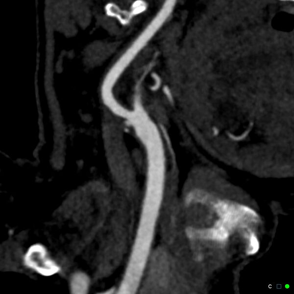 File:Non-occlusive intraluminal internal carotid artery thrombus (Radiopaedia 37751-39658 C 25).jpg