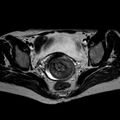 Non-puerperal uterine inversion (Radiopaedia 78343-90983 Axial T2 20).jpg