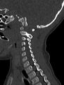 Normal CT cervical spine - pediatric (Radiopaedia 52549-58462 Sagittal bone window 63).jpg