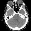 Normal CT of the neck (Radiopaedia 14575-14500 Axial C+ 8).jpg