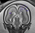Normal brain fetal MRI - 22 weeks (Radiopaedia 50623-56604 Lamination 1).jpg
