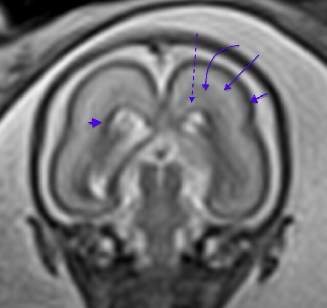 File:Normal brain fetal MRI - 22 weeks (Radiopaedia 50623-56604 Lamination 1).jpg
