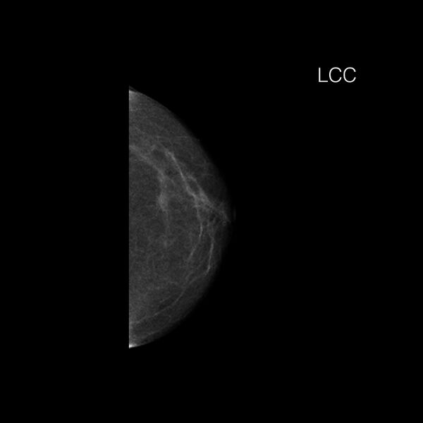 File:Normal breast mammography (tomosynthesis) and ultrasound (Radiopaedia 65325-74355 B 1).jpeg