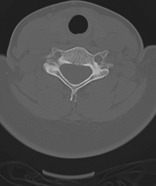 File:Normal cervical spine MRI (including Dixon) (Radiopaedia 42762-45926 Axial bone window 39).png