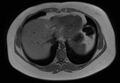 Normal liver MRI with Gadolinium (Radiopaedia 58913-66163 Axial T1 in-phase 28).jpg