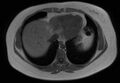 Normal liver MRI with Gadolinium (Radiopaedia 58913-66163 Axial T1 in-phase 29).jpg