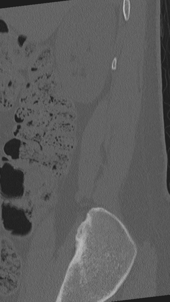 File:Normal lumbar spine CT (Radiopaedia 46533-50986 Sagittal bone window 95).png