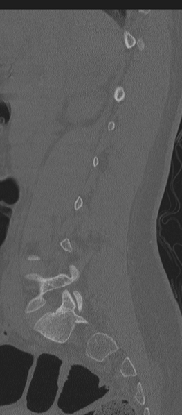 File:Normal lumbosacral CT (Radiopaedia 37923-39867 Sagittal bone window 66).png