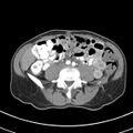 Normal multiphase CT liver (Radiopaedia 38026-39996 B 55).jpg