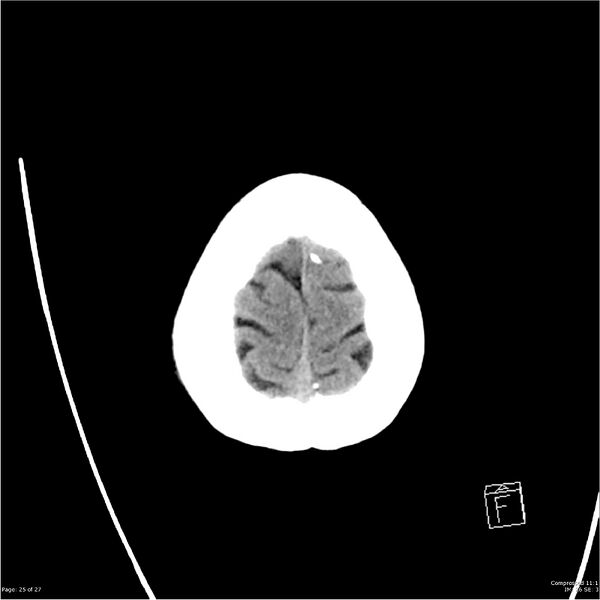 File:Normal pressure hydrocephalus (Radiopaedia 24415-24736 Axial non-contrast 22).jpg