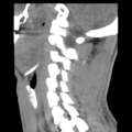 Normal trauma cervical spine (Radiopaedia 41017-43760 B 19).png
