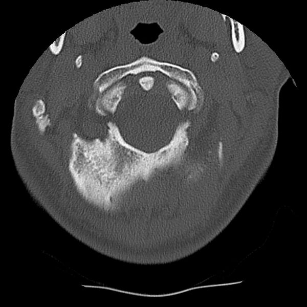 File:Normal trauma spine imaging (Radiopaedia 31753-32686 Axial bone window 6).jpg