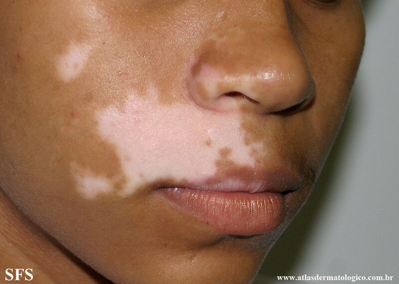 File:Vitiligo (Dermatology Atlas 61).jpg